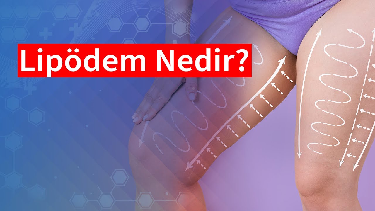 Lipödem nedir